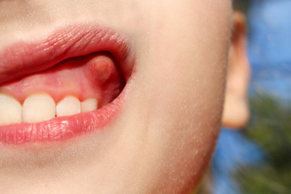 Dental abscesses are accumulations of pus from a bacterial infection.