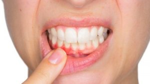 Dental Abscesses and How to Treat Them