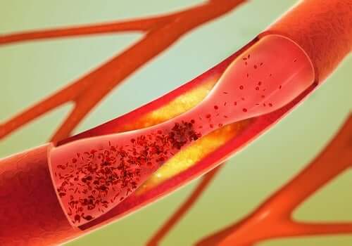 A cerebrovascular accident.
