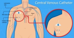 Vascular Perforation and Central Venous Catheters