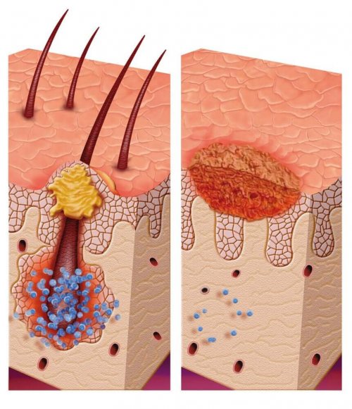 A diagram of a multiple pilomatrixoma.
