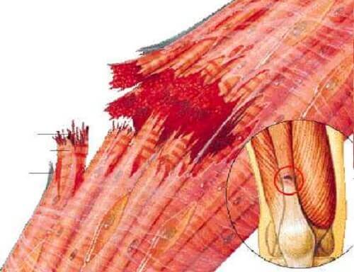 A drawing of a muscle strain.