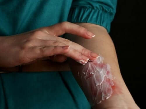 A person applying ointment on a burn.