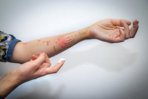 How to Treat a Superficial Burn