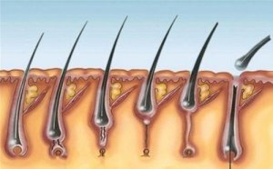 Multiple Pilomatrixoma Syndrome