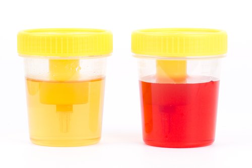 Blod i urinen ses i urinprøve