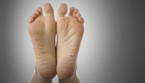 Cryotherapy is a way to treat plantar warts.