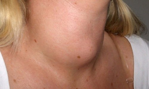 A lump in the neck.