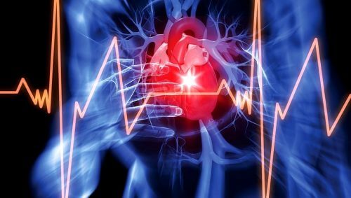 Pericardial effusion.
