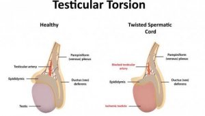 Testicular Torsion: Symptoms and Causes
