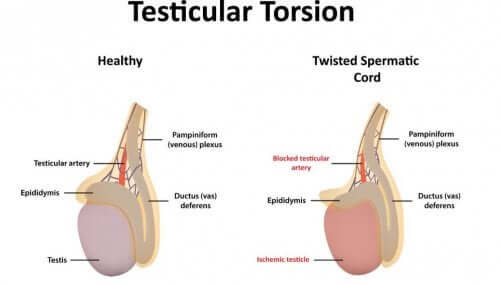 Testicular Torsion: Symptoms and Causes