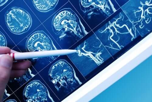 What's Vascular Dementia?