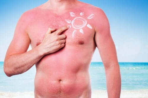 A sunburnt man.