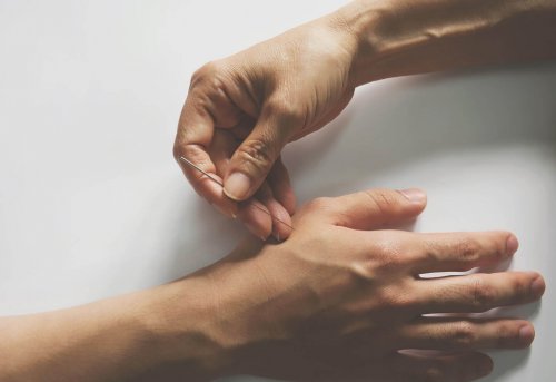 Person sticking a needle into another person's hand acupuncture