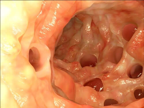 Meckel's Diverticulum and its Characteristics