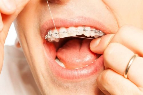 A person with orthodontics flossing.