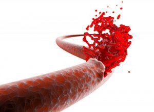 The Risks of Post-Operative Bleeding