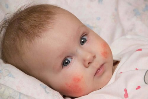 A baby with a face rash.