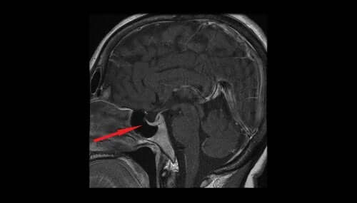 What's a Pituitary Adenoma?