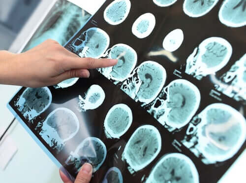 Alzheimers kan behandlas med donepezil.