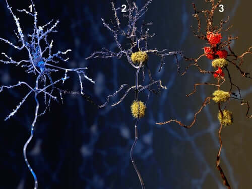 Alzheimers kan behandlas med donepezil.