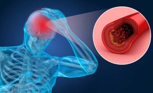 Stroke Risk Factors and Symptoms