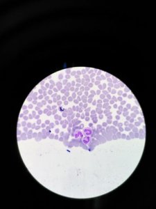 Agranulocytosis: Symptoms and Treatments