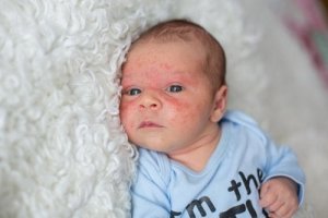 The Differences between Atopic and Seborrheic Dermatitis