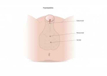 The Symptoms And Treatment Of Hypospadias Step To Health The Symptoms And Treatment Of Hypospadias Step To Health
