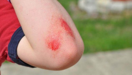 Scraped elbow.