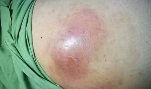 What are Intra-Abdominal Abscesses?