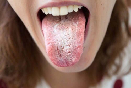 A woman with a white tongue.
