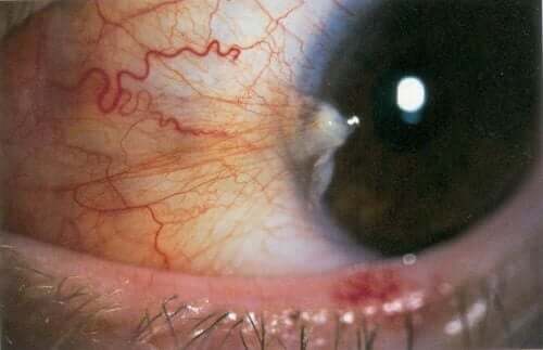 Inaktiv pterygium i ögat