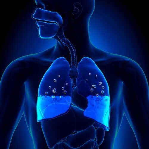 Pulmonary Edema: Symptoms and Causes