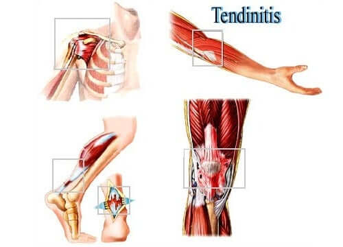 A representation of tendonitis.