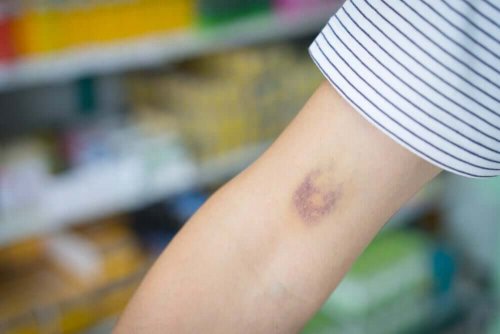 A person with a bruise.