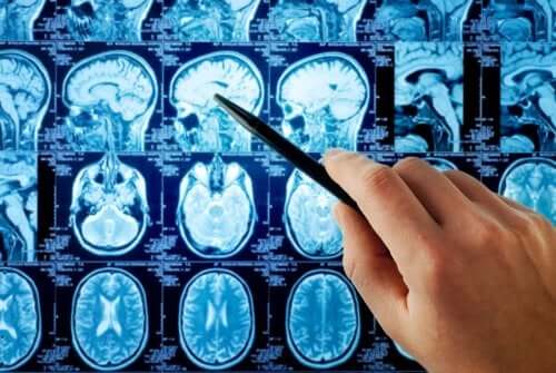 En person som pekar på hjärnmetastaser i en röntgen.