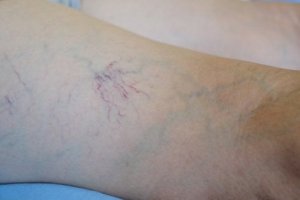 Venoruton - Characteristics and Uses