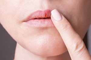 Herpes Simplex Viruses and Their Characteristics