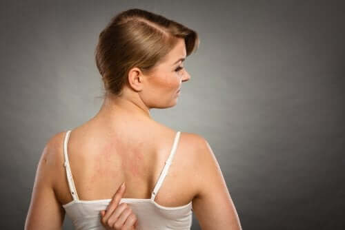 A woman with a rash on her back.
