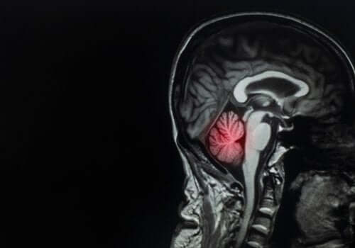 Brain Metastases: Description and Treatment