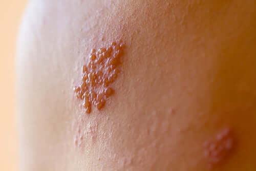 Closeup of skin with boils.