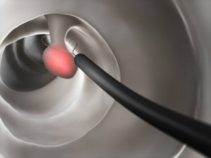 Colorectal Polyps - Characteristics and Symptoms