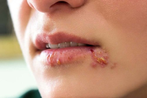There are various manifestations of the types of oral herpes.