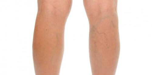 Varicose veins on a pair of legs.