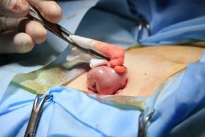 What’s a Colostomy?