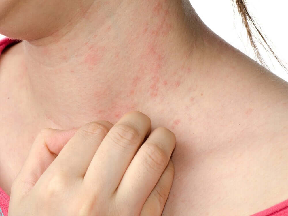 Dermatitis or eczema on neck