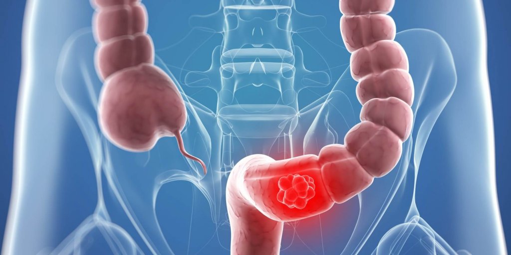 What’s a Colostomy? - Treatments - Step To Health