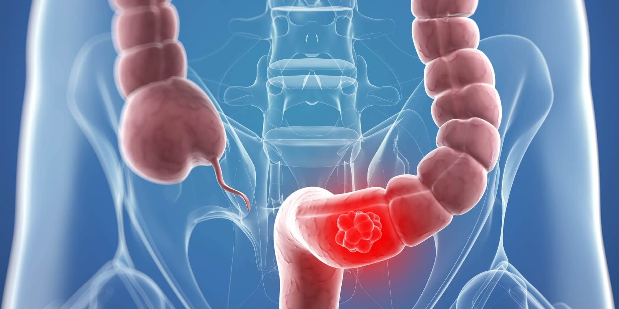 A digital representation of a colostomy.