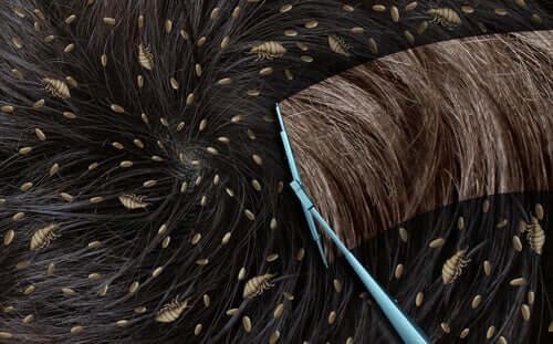 Get rid of nits quickly before they hatch